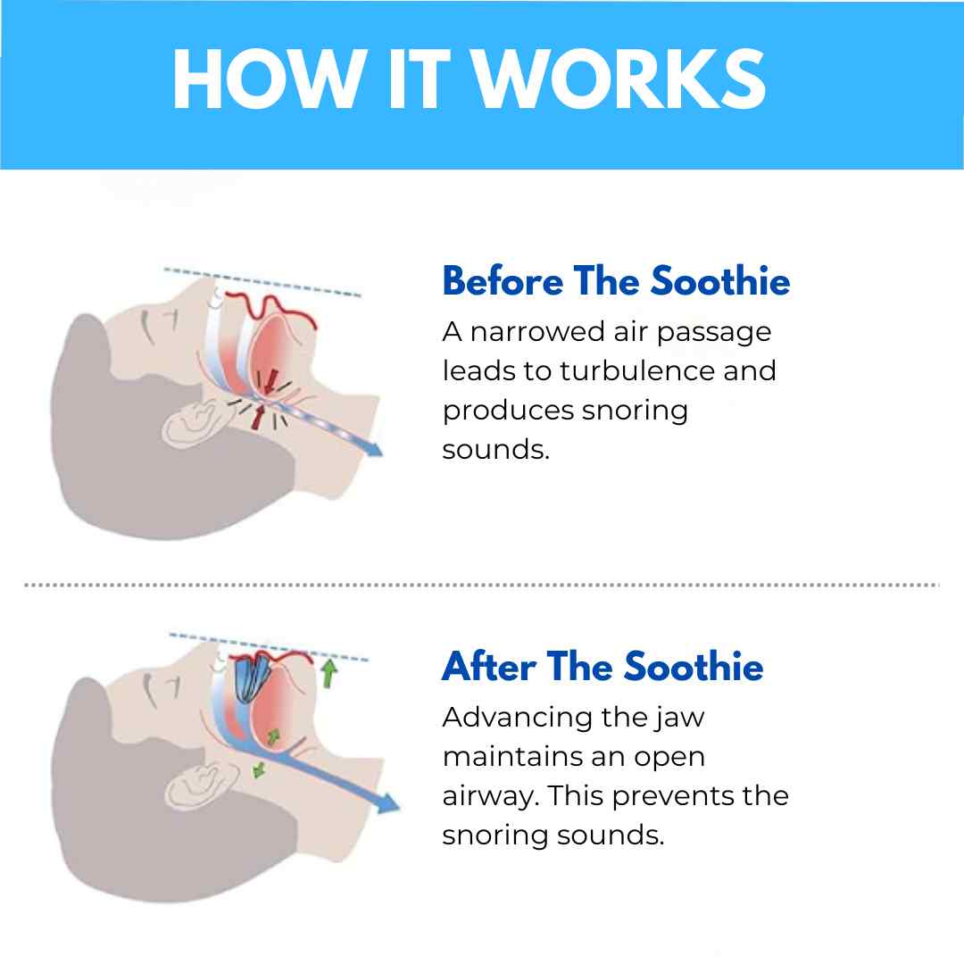 SnoreSoothie® Anti Snoring Mouthpiece