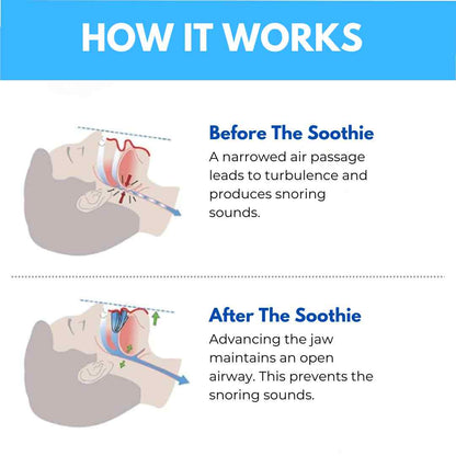 SnoreSoothie® Anti Snoring Mouthpiece